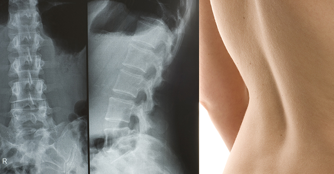 https://lifemoves.ca/wp-content/uploads/2010/07/Sciolosis-Spine-Xray.jpg