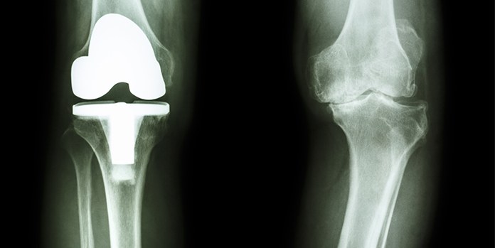 Knee Joint Replacement X-Ray