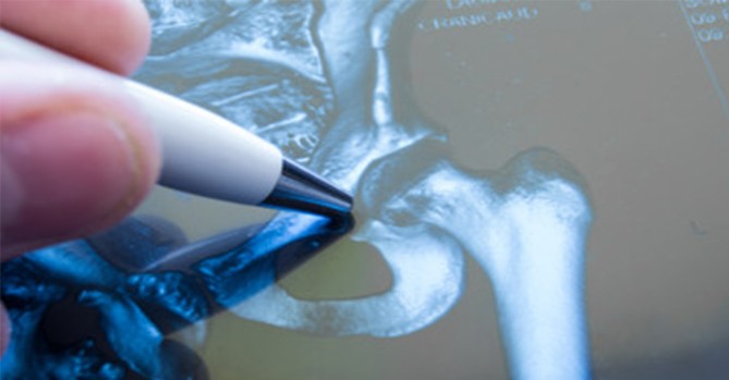 For Active Patients, Anterior Hip Replacement Surgery May Shorten